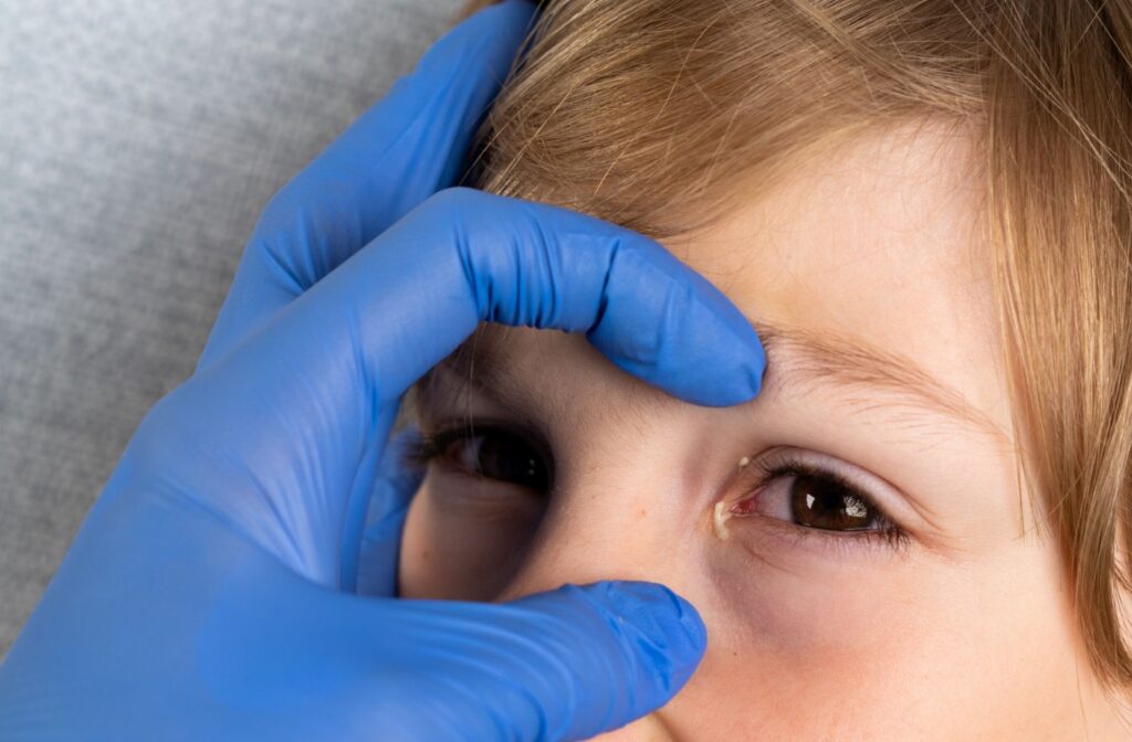 A close-up of a child’s eye showing signs of irritation and discharge.