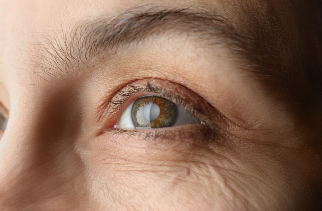 Close-up of a brown eye with cloudy grey lens.